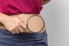 Stretch Mark Removal Procedures