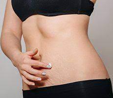 Stretch Mark Surgery - Knowing Your Option