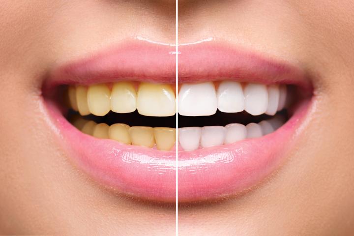 7 Myths About Teeth Whitening That Should Be Addressed