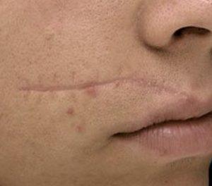 Scar Removal With Laser Treatments