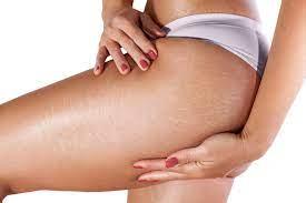 How Does Laser Stretch Mark Removal Work?